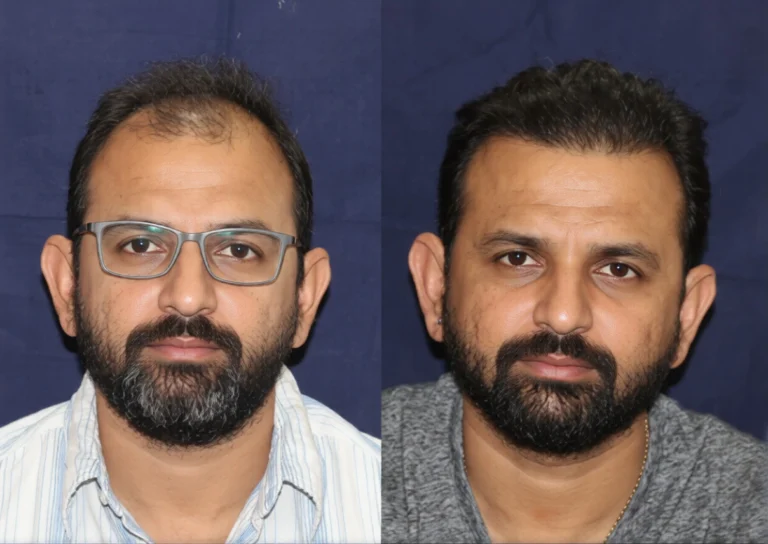 Hair Transplant Results