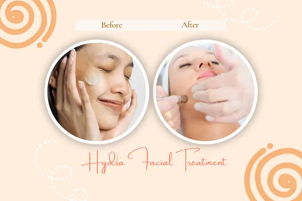 Hydra Facial Treatment