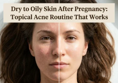 Dry to Oily Skin After Pregnancy: Topical Acne Routine That Works