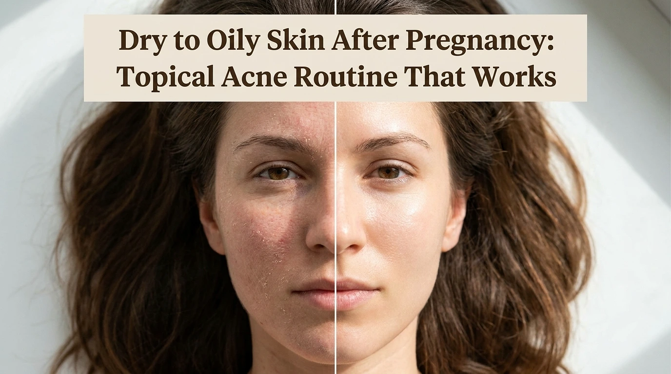 Dry to Oily Skin After Pregnancy: Topical Acne Routine That Works