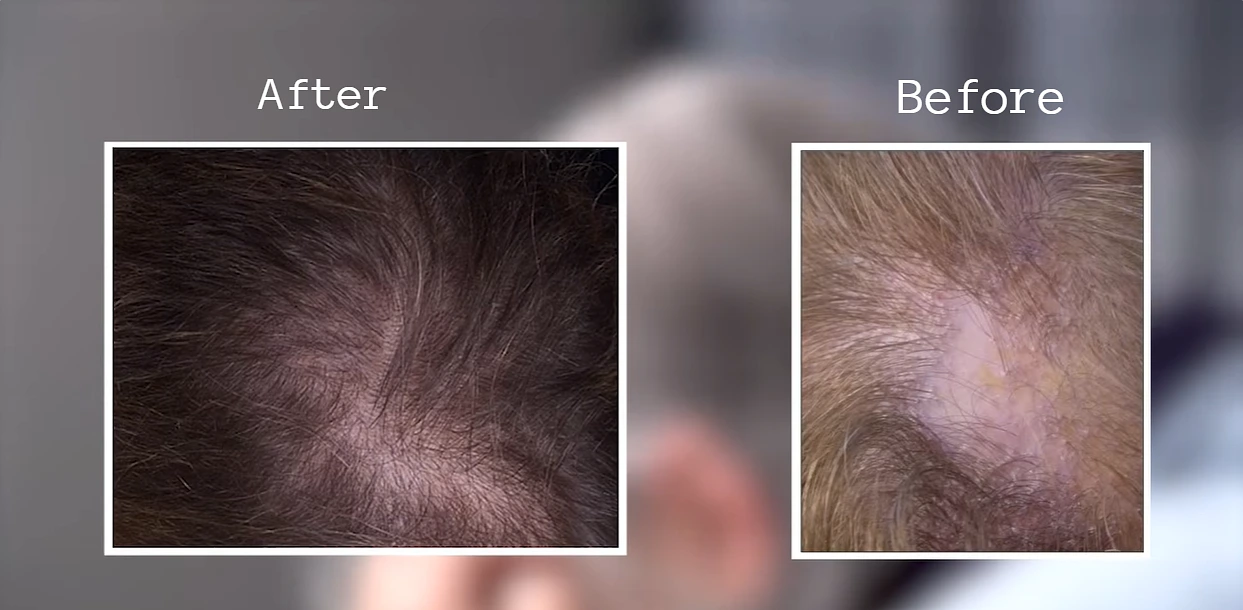 Hair Falling Out 3 Months After Hysterectomy? Why It Happens